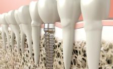 Why a bone graft is important, 3D diagram of a dental implant
