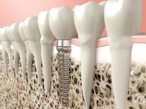 Why a bone graft is important, 3D diagram of a dental implant