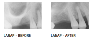L.A.N.A.P &#8211; Laser-Assisted New Attachment Procedure